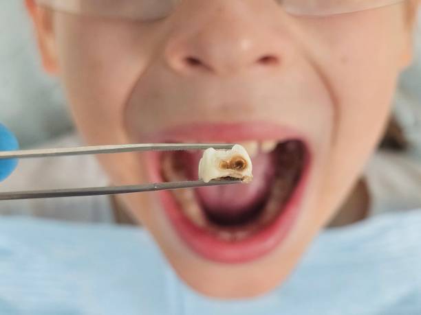 Best Urgent Tooth Repair  in Maltby, WA
